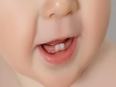 پوسیدگی دندان کودک